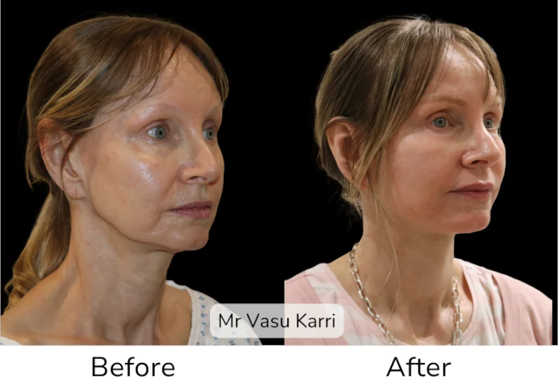 Facelift Patient 16 View 2